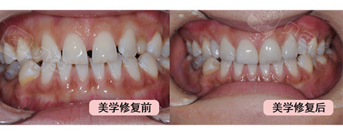 贝色专栏 >  详细页面牙齿贴面可修复:各类色素牙,烟渍牙,牙缝大,瓜子