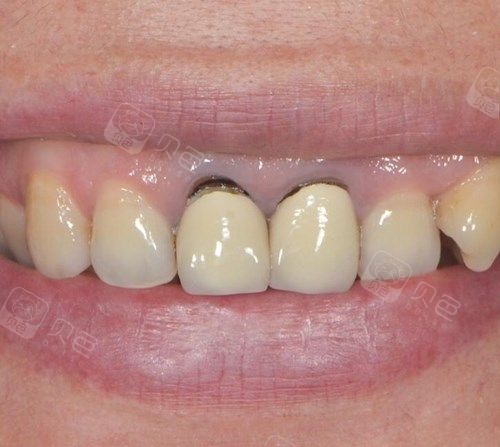 我作了全瓷牙能扣到缝没事吗?全瓷牙免费重做的条件