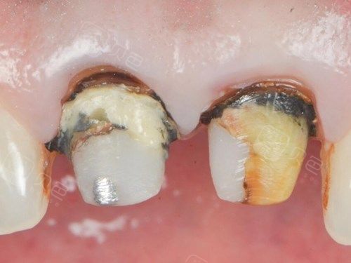 情况,是可以要求医院重做的,比如:因为装了烤瓷牙之后牙齿磨得不到位