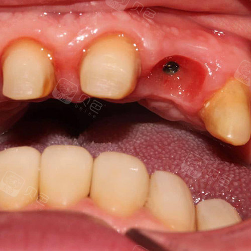 种植牙二期佩戴牙冠