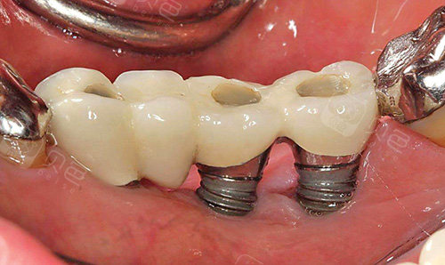 种植牙植体暴露