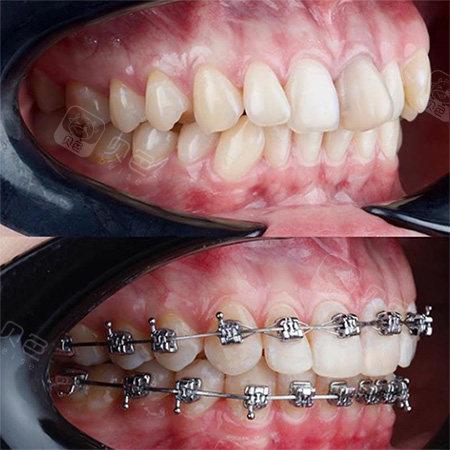 大龄女青年矫正牙齿效果,我来告诉你自锁牙套矫正效果如何!