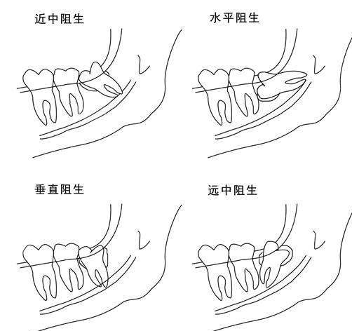 听说智齿不拔会引发凸嘴龅牙,阻生齿很难拔是真的吗?
