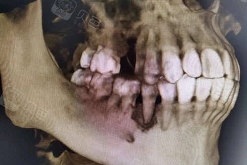 搞不好牙槽骨会被吸收