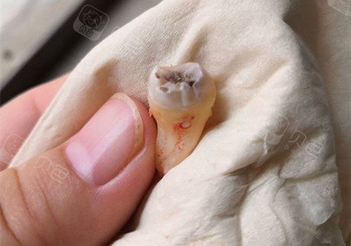 后半年拔掉两颗智齿一颗完全龋坏一颗超长带弯钩