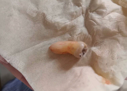 后半年拔掉两颗智齿一颗完全龋坏一颗超长带弯钩