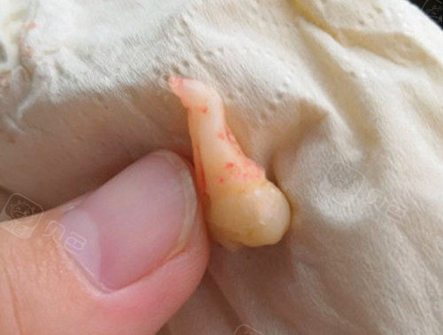 后半年拔掉两颗智齿一颗完全龋坏一颗超长带弯钩