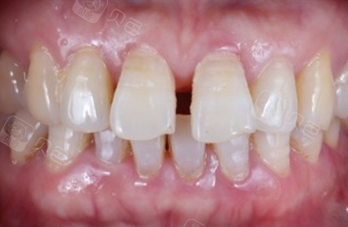 门牙牙缝很大我上个月到南通玉蕙口腔医院做了全瓷贴面