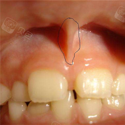 重庆哪家医院做唇系带好做唇系带要注意什么