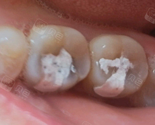 做根管治疗后封药