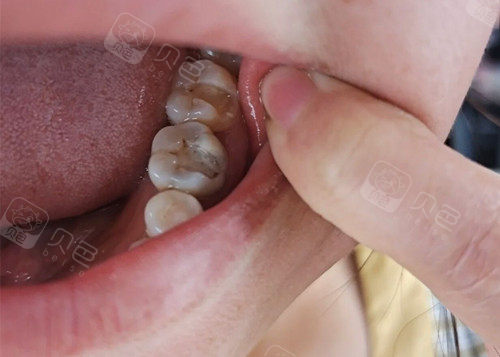 给大家看看根管治疗后我的牙齿 医生还说要我做烤瓷牙