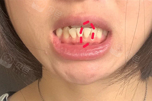 洗牙后有黑三角