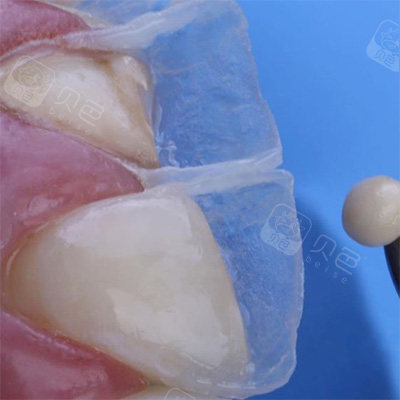 我在南京美奥用树脂补门牙前后对比效果,我妈以为我换牙了!