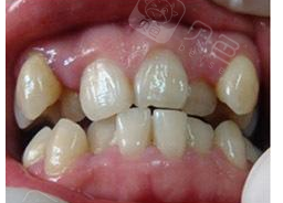 孩子牙齿拥挤不齐