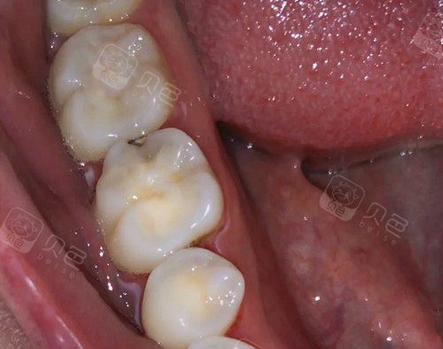 不大的牙齿龋洞里面烂了一半是做补牙还是戴假牙呢