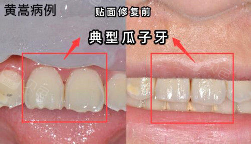 上海华美齿科今日份案例分享全瓷贴面修复典型瓜子牙