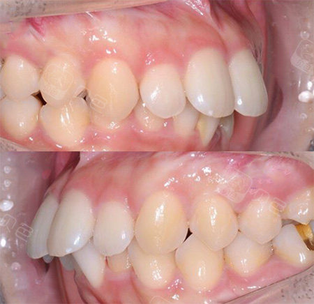 来分享一下凸嘴女孩的牙齿矫正前后效果,庆幸自己的选择