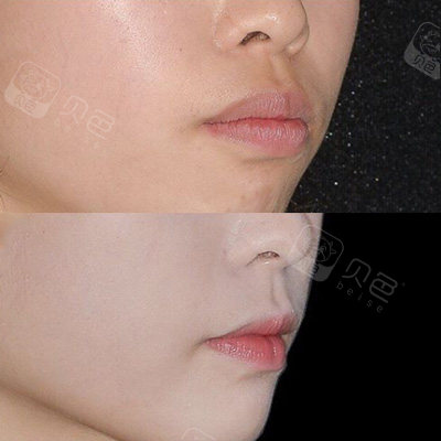 来分享一下凸嘴女孩的牙齿矫正前后效果,庆幸自己的选择