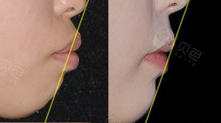 侧面牙齿矫正前后对比