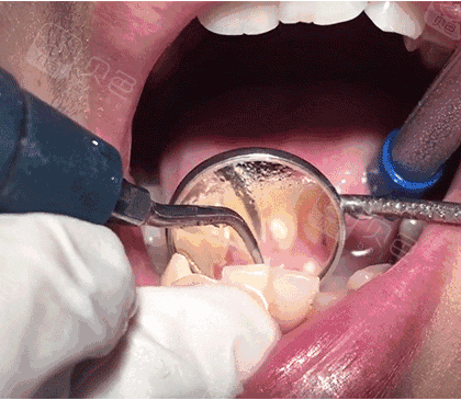 那龈下刮治是什么呢?如果说洗牙是去除牙齿表面的牙结石.