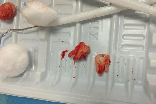 拔掉的两颗智齿