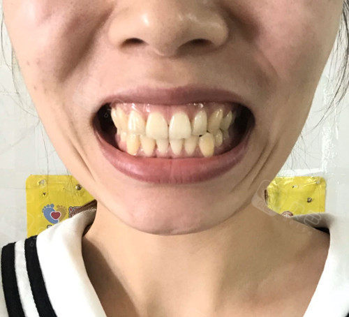 28岁的我好想整牙但医生说要拔牙4颗 瞬间秒怂