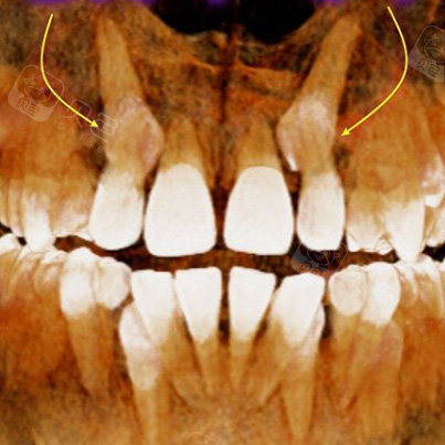 打算矫正才发现这两颗埋伏牙害苦我了!