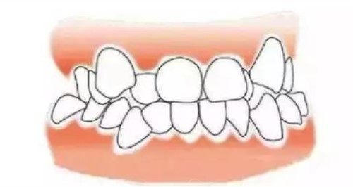 牙齿拥挤示意图