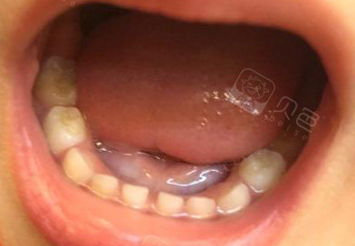 全口涂氟后的牙齿