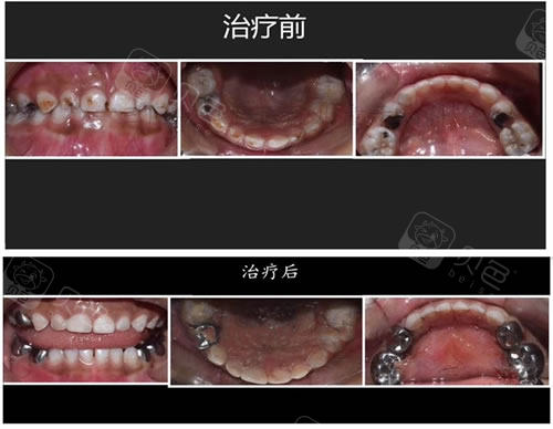 济南全好口腔医院儿童龋齿对比案例