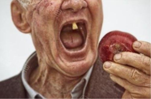 种植牙有什么优点呢?