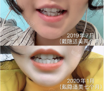 隐形牙套怎么样上海哪家医院做隐形矫正效果好