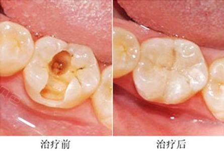 龋齿种牙修复前后对比照片