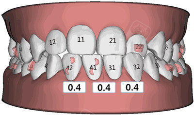 多图记录我在临沂市银座牙客口腔做牙齿矫正的全部过程! - 贝色口腔