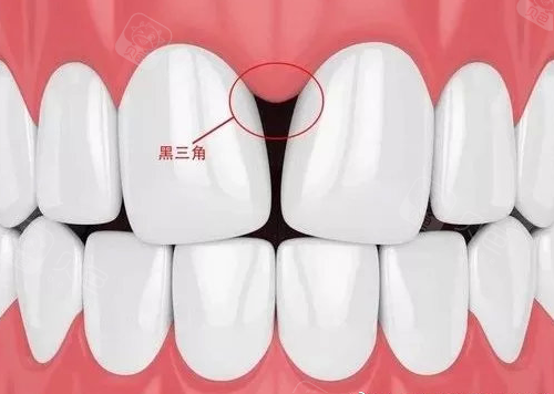 牙齿矫正会有黑三角出现重庆爱思特口腔邓兴捷告诉你真相