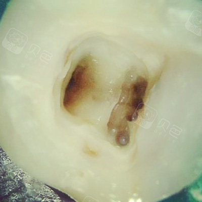 牙齿根管治疗开髓