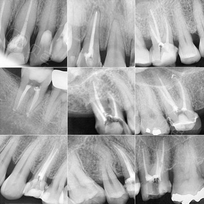南京根管治疗一颗牙齿多少钱?有没有一次性搞定的那种?