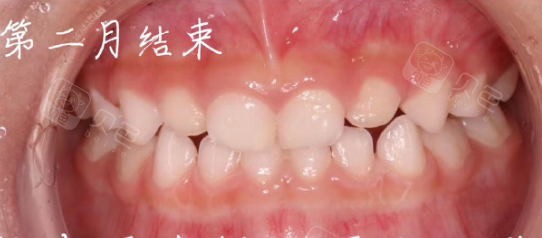 孩子地包天,在长春拜博口腔2个月就矫正好了