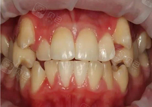 由于并列横生的两颗智齿,积压了正常牙齿的生长环境,需要拔除之后再