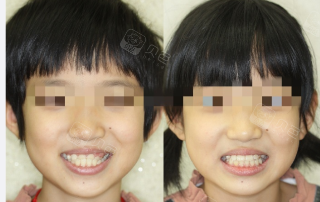 这是一个孩子的地包天矫正案例,矫正前后对比很明显.