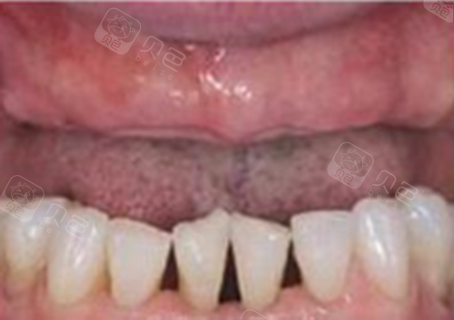 老人半口牙缺失怎么办?中山好民生口腔all-on-4种植