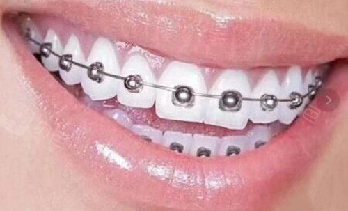 obrace球面矫正器外观上从之前的方形托槽升级成为半球形,托槽的表面