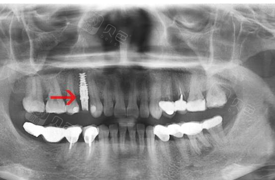 我在长春欣雅花1万6做的诺贝尔种植牙后2年的感受
