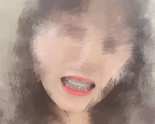 深覆合矫正后像垫下巴,重庆深覆合矫正哪家比较好?