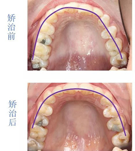 牙弓不对称扩弓矫正