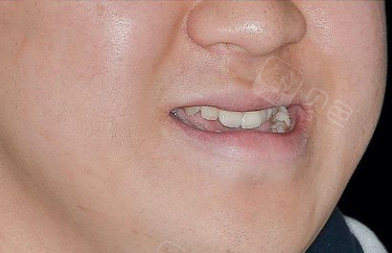 看我地包天矫正后脸型前后变化,我妈都夸我颜值上升不少!