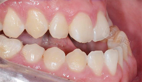 牙齿地包天矫正前样子