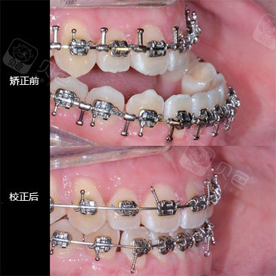 看我地包天矫正后脸型前后变化,我妈都夸我颜值上升不少!