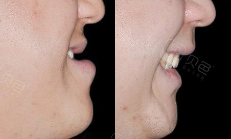 看我地包天矫正后脸型前后变化,我妈都夸我颜值上升不少!