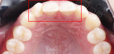 牙齿内扣有必要矫正吗?只要是影响咬合关系还是要矫正!